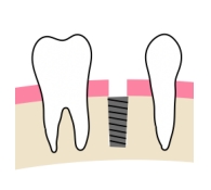 インプラント治療とは？