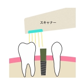 インプラント治療とは？