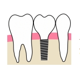 インプラント治療とは？
