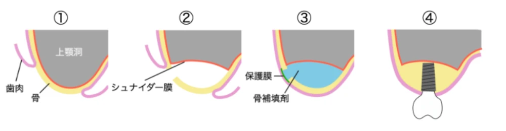 サイナスリフト（上顎洞底挙上術）の治療の流れ