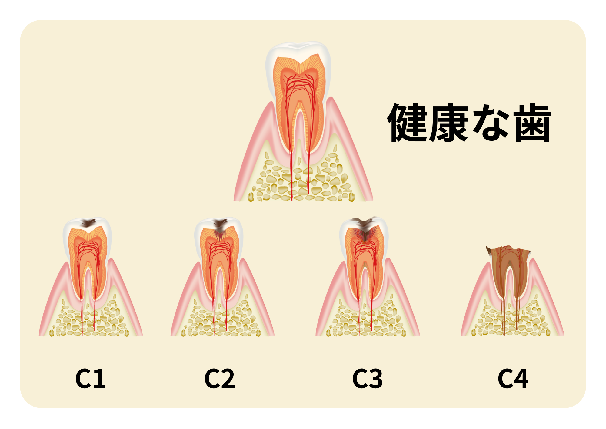 虫歯の進行