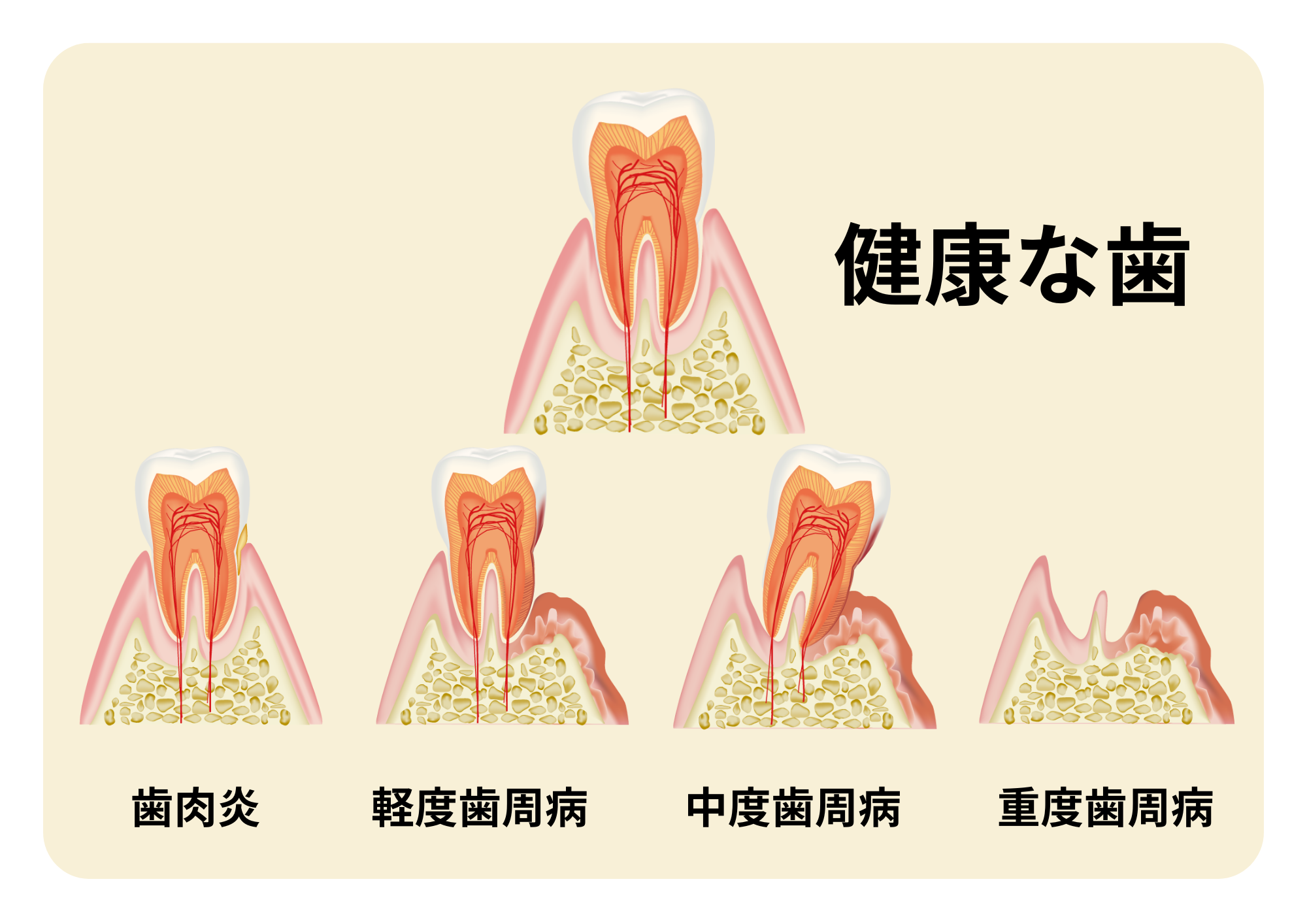 歯周病の進行　ステージ