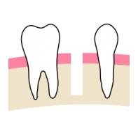 インプラント治療とは？